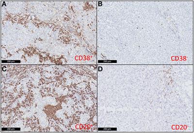 High Densities of Tumor-Associated Plasma Cells Predict Improved Prognosis in Triple Negative Breast Cancer